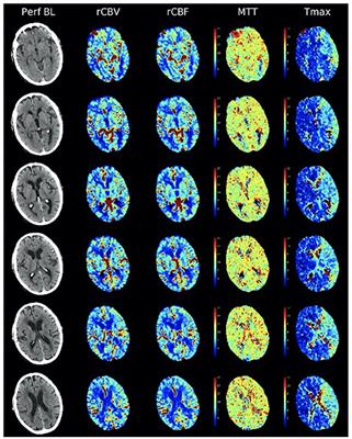 Precision Medicine for Intracranial Atherosclerotic Disease